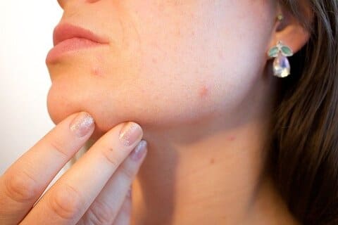 Rozenbottelolie tegen acne en rosacea